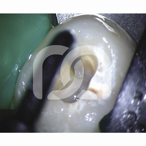 TIPS START-X - TIPS N°1 COMPATIBLE SATELEC TIPS START-X - TIPS N°1 COMPATIBLE SATELEC
