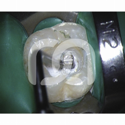 TIPS START-X - TIPS N°1 COMPATIBLE SATELEC