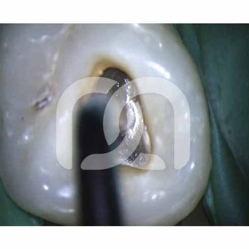 TIPS START-X - TIPS N°1 COMPATIBLE SATELEC TIPS START-X - TIPS N°1 COMPATIBLE SATELEC
