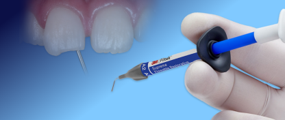 COMMENT RÉPARER UN BORD LIBRE INCISAL