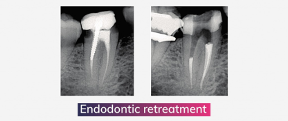 HUGO SETBON : LE RETRAITEMENT ENDODONTIQUE