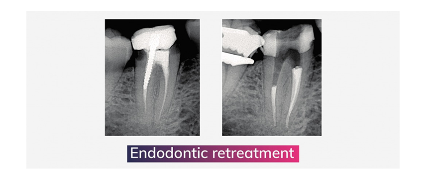 HUGO SETBON : LE RETRAITEMENT ENDODONTIQUE