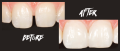 Tout savoir sur la fermeture de diastème.